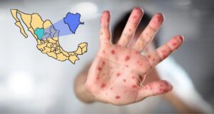 Durango registra 185 casos de sarampión; 93 son menores de 12 años